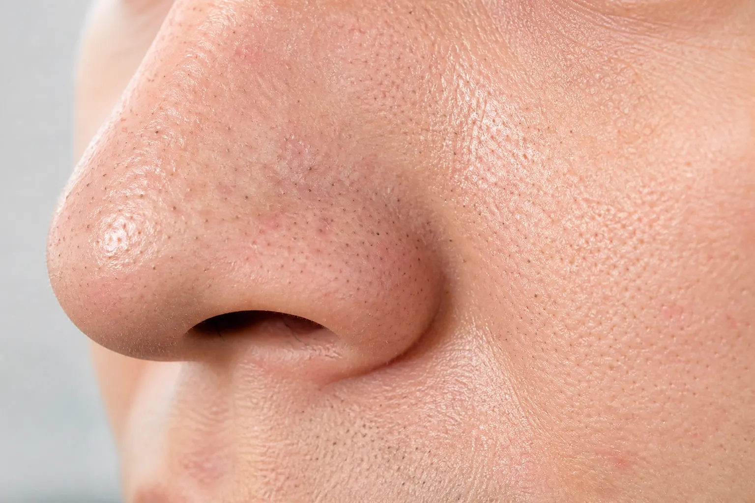Close-up of blackheads in facial pores