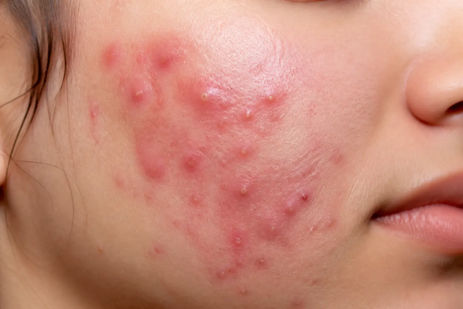 Close-up of red swollen inflamed acne